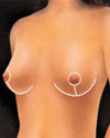 mamoplastia05