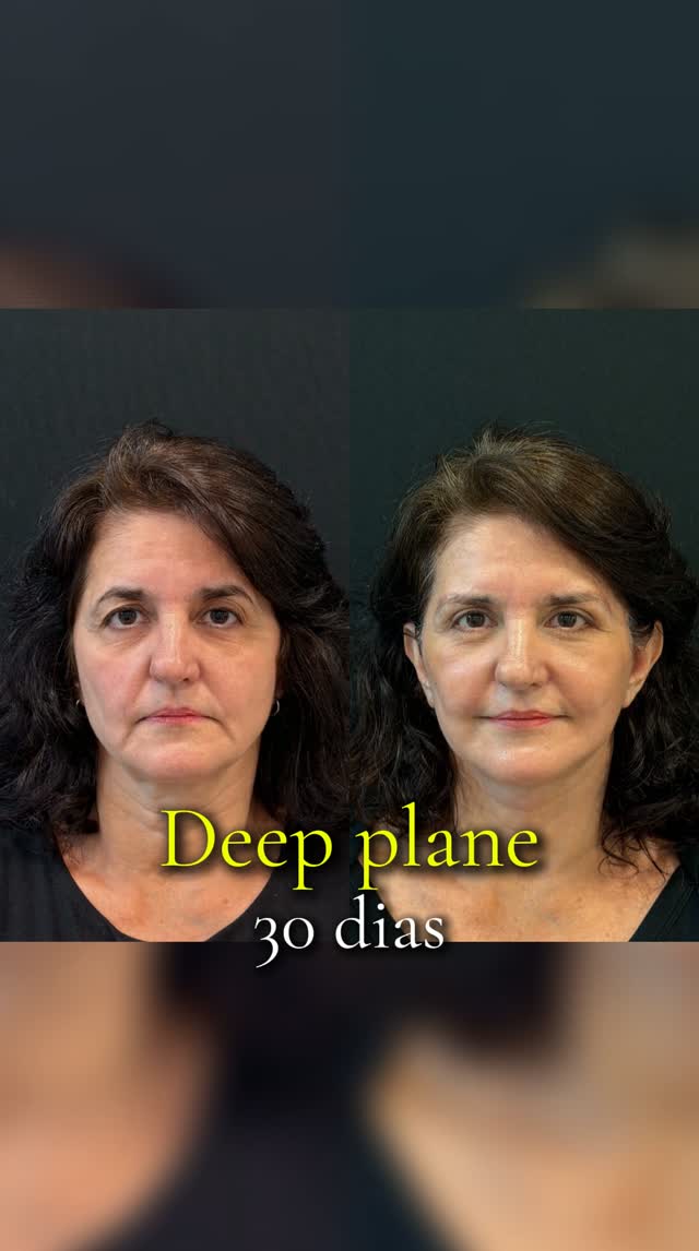 Como é a recuperação com 30 dias de pós-operatório?