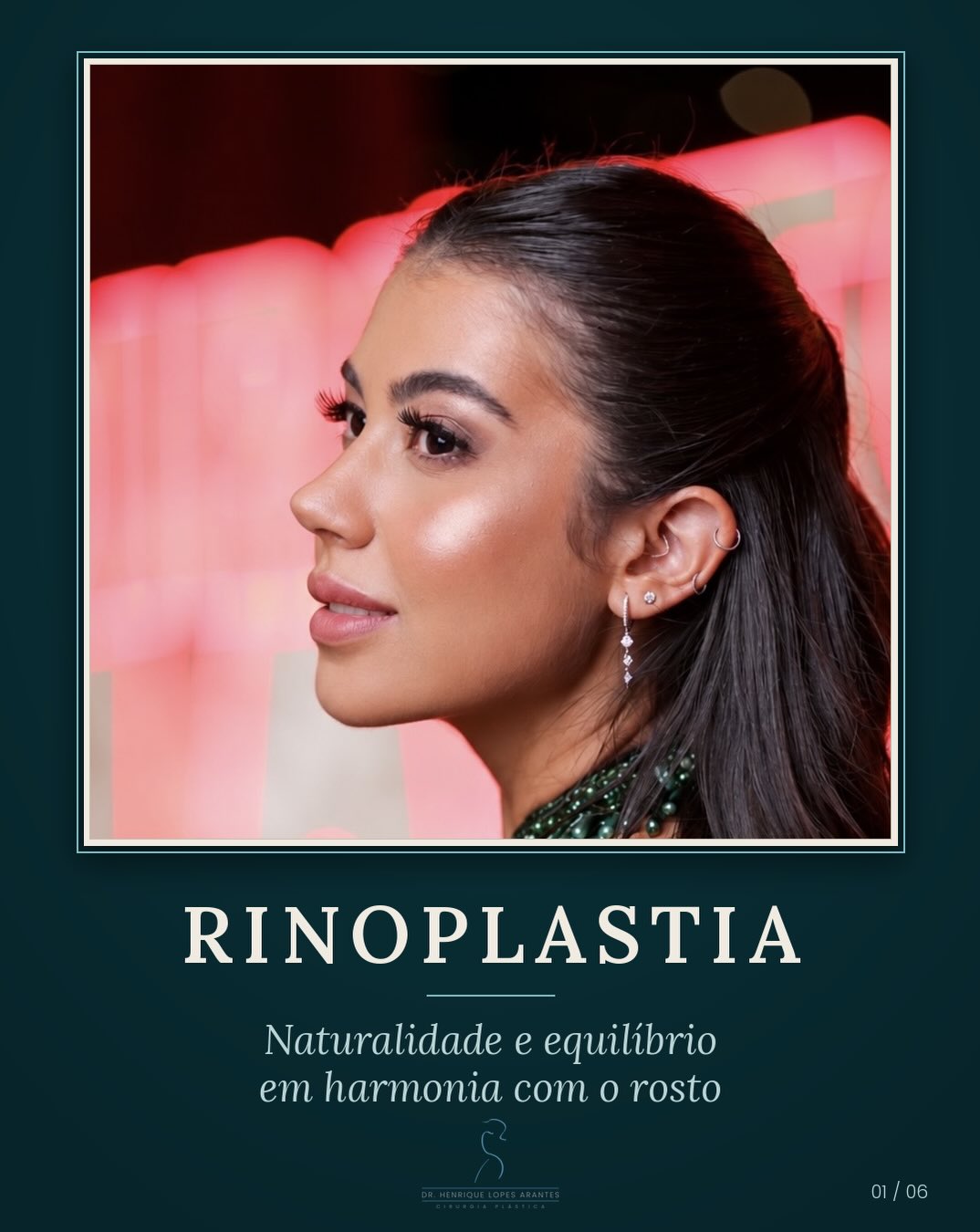 Rinoplastia | 6 meses de pós-operatório